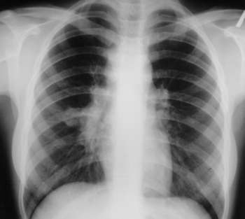 Как выглядит рентген грудной клетки в Зеленограде
